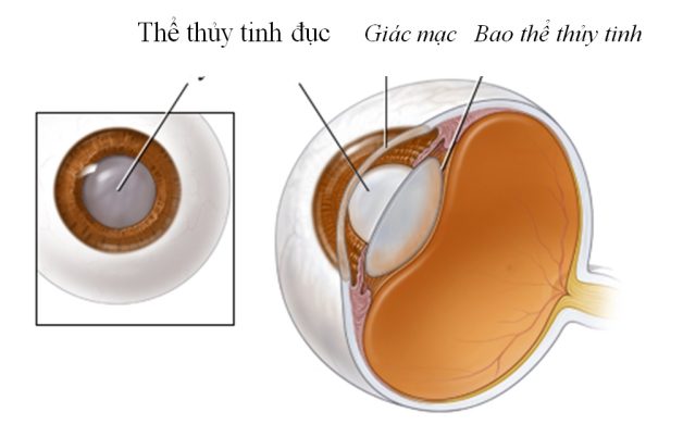 Thủy tinh thể chịu trách nhiệm dẫn truyền ánh sáng vào võng mạc