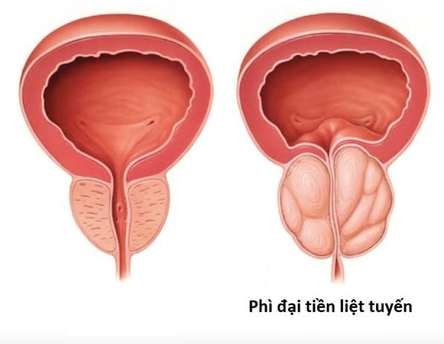 Sỏi kẹt cổ bàng quang - Mức độ nguy hiểm và cách điều trị