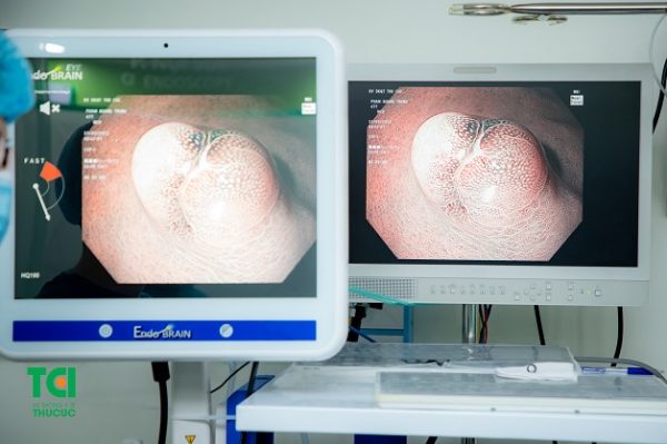chẩn đoán bệnh đau ruột già do polyp
