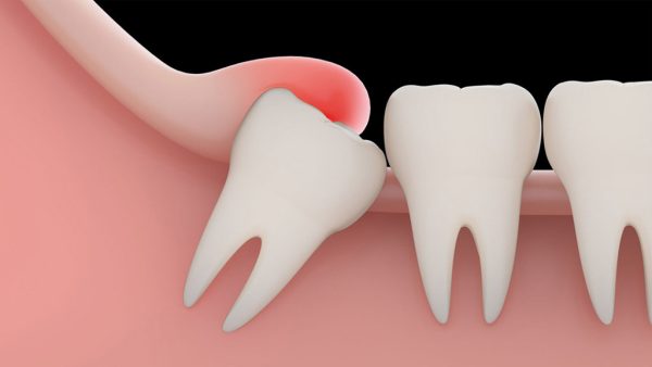 sâu răng số 8