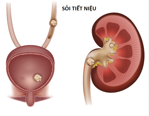 Những thông tin về các phương pháp điều trị sỏi tiết niệu