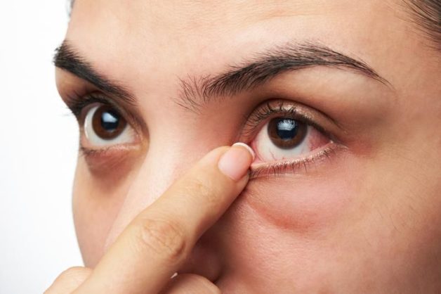 Dụi mắt là một nguyên nhân gây viêm mí mắt dưới