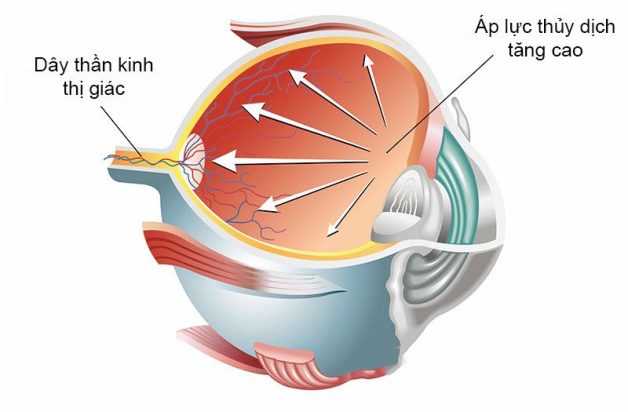 tăng nhãn áp có chữa được không gây nhiêu băn khoăn cho người bệnh