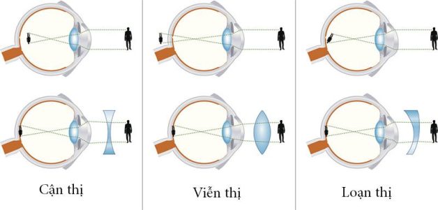 thị lực kém