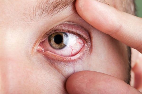 Một trong những dấu hiệu cho thấy trẻ đang thiếu máu là niêm mạc mắt nhạt màu