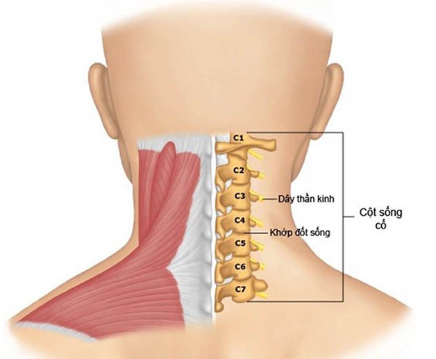 Vôi hóa đốt sống cổ là tình trạng tích tụ canxi quá mức tại các đốt sống
