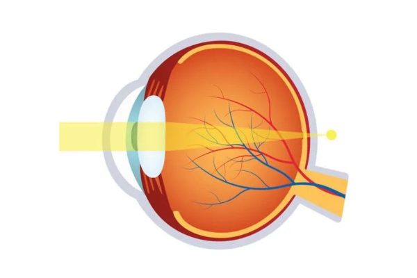 Viễn thị là tình trạng hình ảnh hội tụ vào sau võng mạc khiến trẻ khó nhìn được vật ở gần
