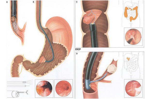 Nội soi là một trong những biện pháp giúp xác định tình trạng bệnh về dạ dày