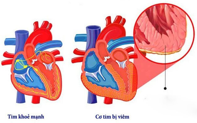 Sốt siêu vi có nguy hiểm không