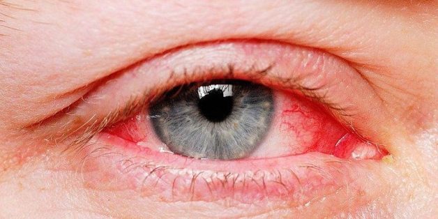 triệu chứng đau mắt đỏ ở trẻ em
