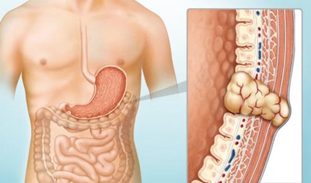 U dưới niêm mạc dạ dày là gì? U có hình dạng đại thể tương tự ung thư
