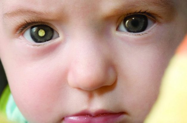 Ánh đồng tử trắng nằm giữa đồng tử mắt trẻ