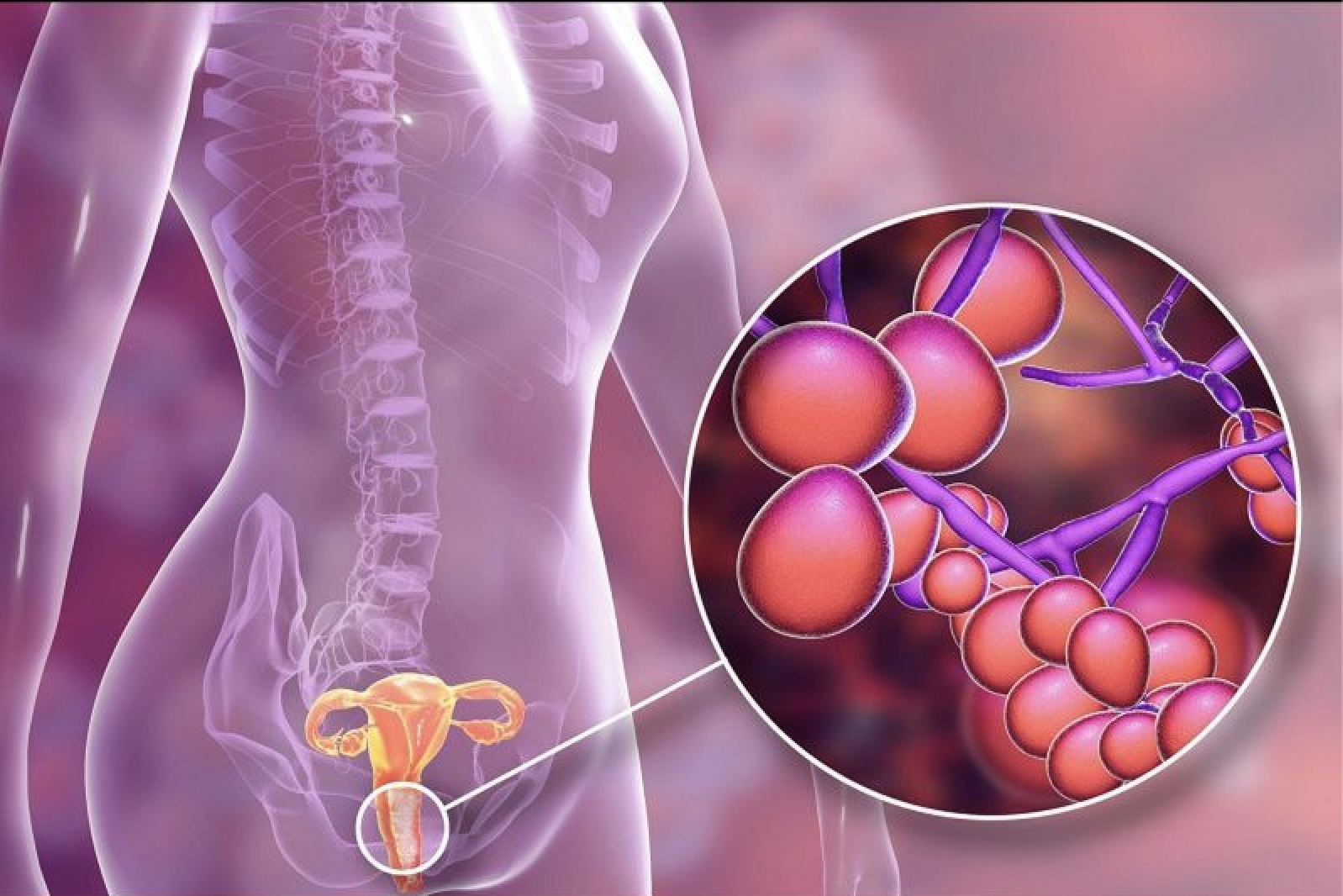 Viêm âm đạo do nấm xảy ra khi nấm Candida albicans phát triển quá mức gây ra kích ứng, viêm, ngứa, đau rát, tiết dịch khu vực âm đạo