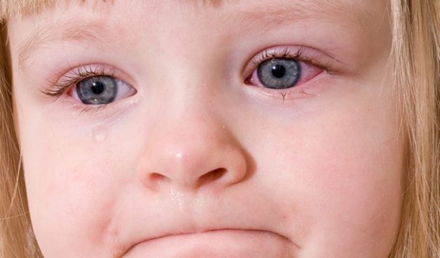 trẻ mắc viêm kết mạc bao lâu thì khỏi