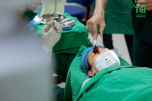 Phẫu thuật điều trị viêm tắc lệ đạo