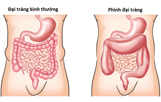 Người bệnh đối mặt với các vấn đề sức khỏe như viêm ruột, tắc ruột và nghiêm trọng nhất là thủng ruột