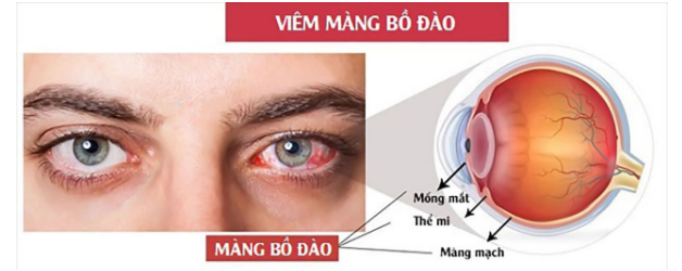 Viêm màng bồ đào là một trong những triệu chứng ngoài tiêu hóa xuất hiện ở người bệnh viêm đại tràng xuất huyết lâu năm