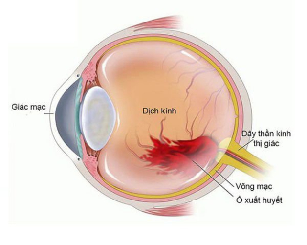 Xuất huyết dịch kính là tình trạng máu rò rỉ vào khoang chứa và hòa chung với dịch kính