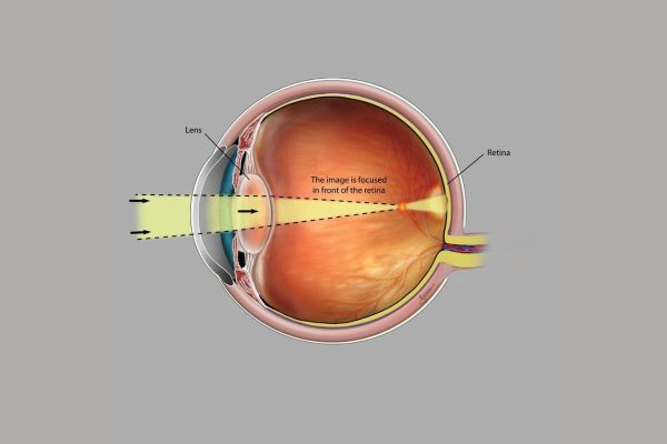 Tình trạng ánh sáng không hội tụ đúng trên võng mạc dẫn tới thị lực bị ảnh hưởng được gọi là tật khúc xạ