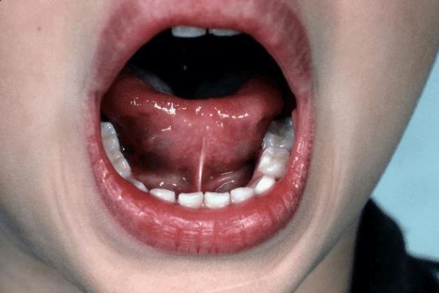 dấu hiệu bé bị dính thắng lưỡi