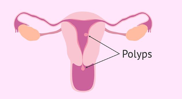 Những hạt polyp tử cung thường có màu hồng, nhạy cảm và dễ chảy máu khi bị chạm vào