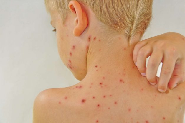 Bệnh tay chân miệng có ngứa không – Chuyên gia giải đáp