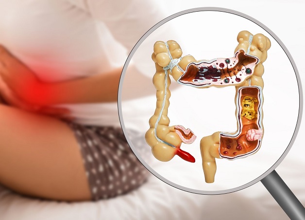 Bệnh viêm đại tràng mãn tính là gì