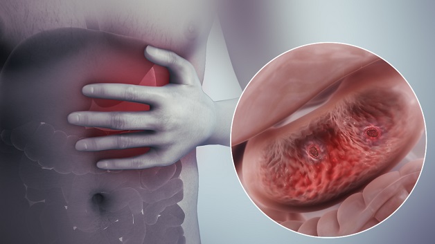Bệnh viêm loét dạ dày cấp tính là gì?