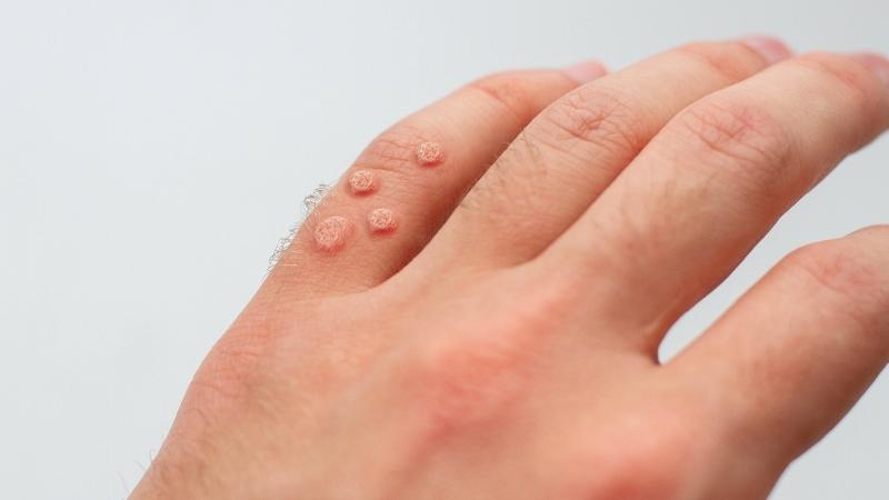 Sùi mào gà là bệnh lây truyền qua đường tình dục phổ biến do virus HPV gây ra