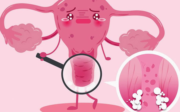 Khi âm đạo bị viêm bạn thường sẽ có những triệu chứng: ngứa ngáy, khó chịu, đau rát khi đi tiểu hoặc quan hệ tình dục