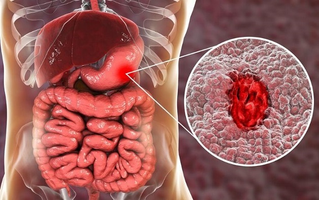 Viêm loét dạ dày là bệnh thường gặp ở hệ tiêu hóa
