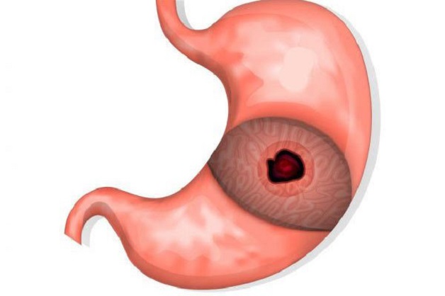 Viêm loét dạ dày có thể gây thủng dạ dày