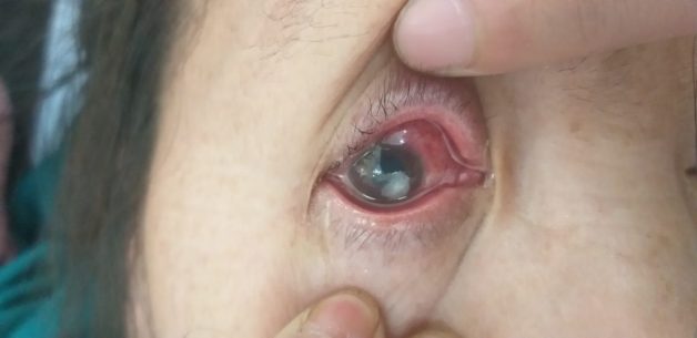 điều trị bệnh viêm loét giác mạc như thế nào