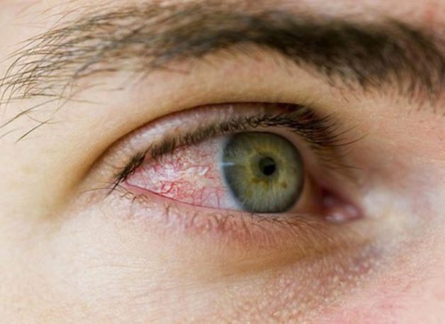 làm thế nào để điều trị bệnh viêm loét giác mạc