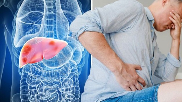 điều trị xơ gan sớm tránh biến chứng