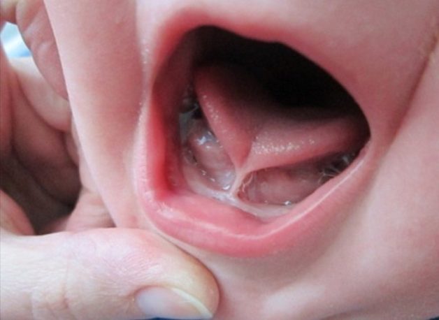 Dính thắng lưỡi hoàn toàn