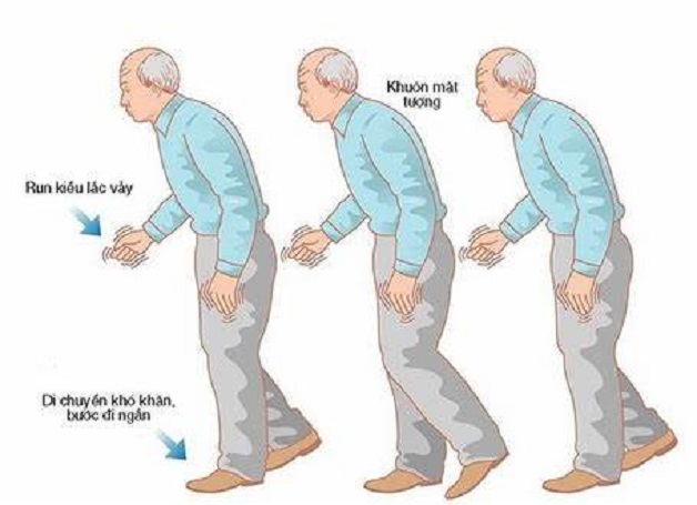 đông cứng dáng đi dấu hiệu bệnh parkinson
