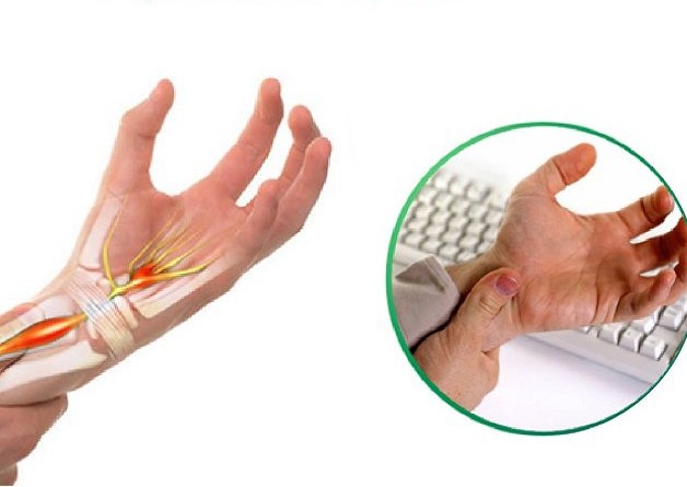 Hội chứng ống cổ tay do dây thần kinh giữa cổ tay bị chèn ép 