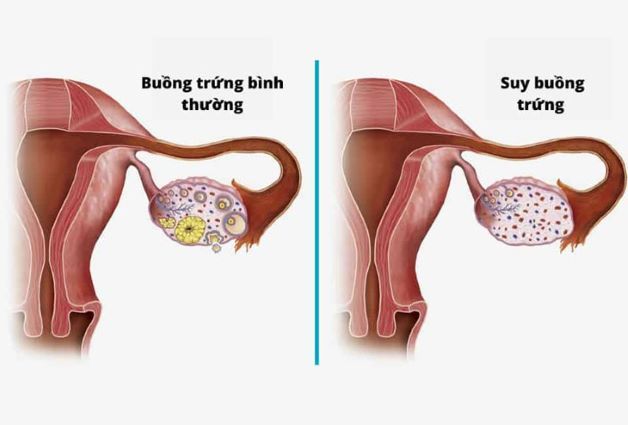 Suy buồng trứng sớm có thể dẫn đến kinh nguyệt không đều gây vô sinh