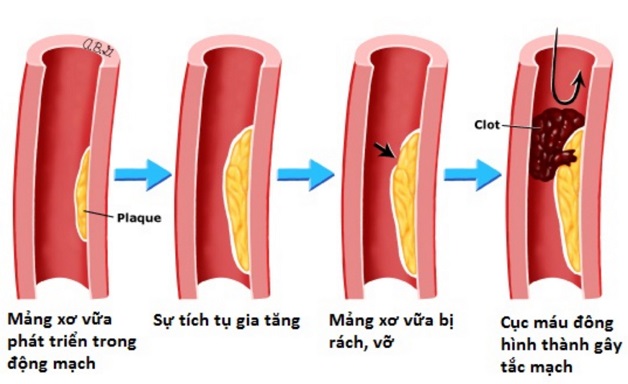 nguyên nhân gây tắc mạch não