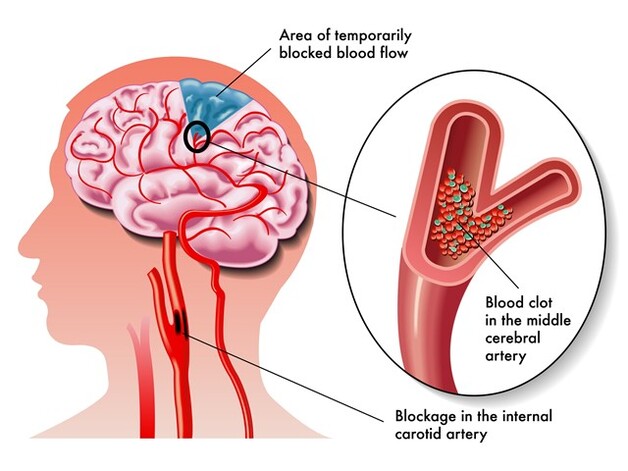 Rối loạn tuần hoàn não có thể gây ra nhức đầu suy giảm trí nhớ