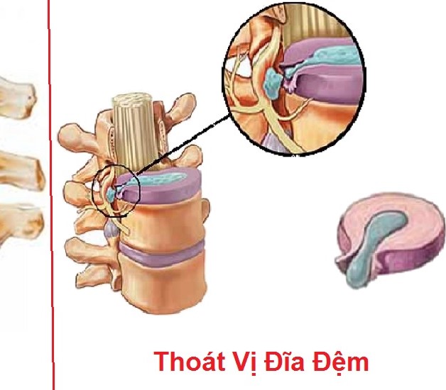 Nếu điều trị thoái hóa cột sống cổ quá muộn có thể dẫn đến thoát vị đĩa đệm