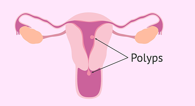 Polyp tử cung hình thành từ sự tăng sinh của tế bào trong nội mạc tử cung, có kích thước lớn nhỏ khác nhau