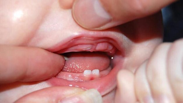 sốt mọc răng ở trẻ