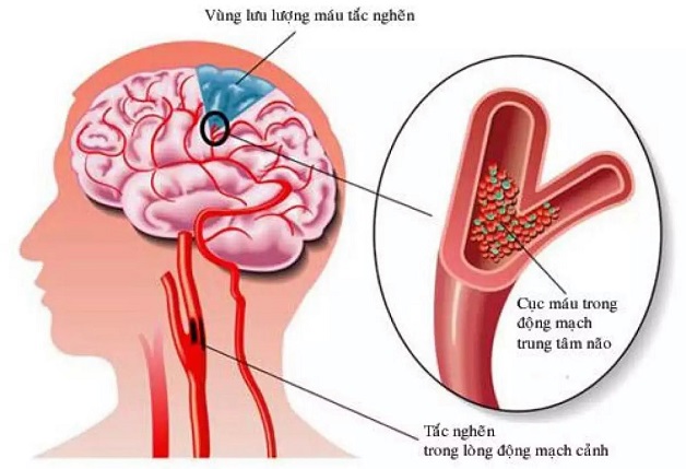 Tắc nghẽn mạch máu não là gì?