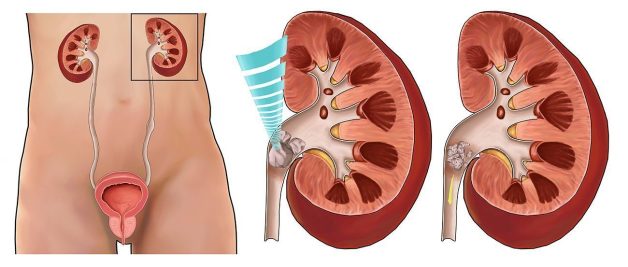 Tổng quan về phương pháp tán sỏi thận ngoài cơ thể