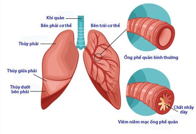 Viêm phế quản là nhiễm trùng khu trú tại phế quản và phế nang của trẻ