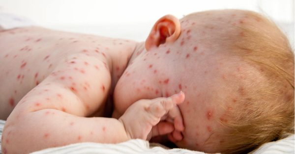Các nốt mụn nước mọc lan rộng toàn cơ thể là triệu chứng thủy đậu ở trẻ trong giai đoạn toàn phát