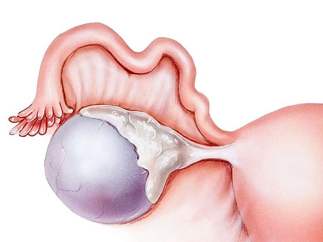 Khối u nang bì buồng trứng là một dạng của u nang buồng trứng, thuộc nhóm u thực thể