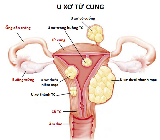 Những khối u xơ tử cung xuất hiện ở nhiều vị trí, thậm chí có thể phát triển, biến chứng và từ đó dẫn tới u xơ tử cung đau bụng dưới